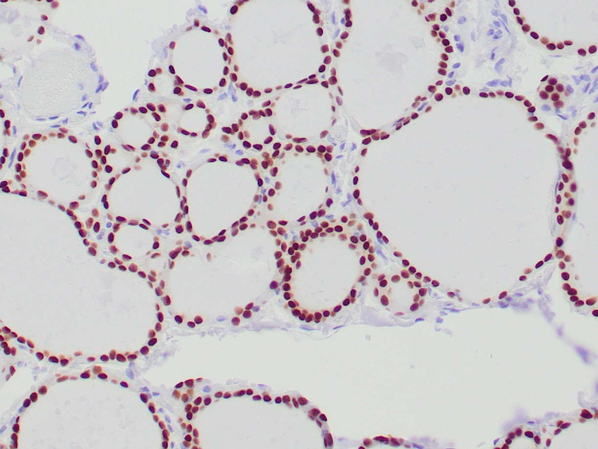 Immunohistochemical staning of a paraffin section of human thyroid tissue using PAX008-0.5, clone ZR1, detecting nuclear PAX-8.